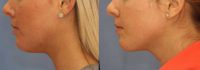 18-24 year old woman treated with Kybella