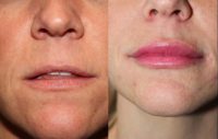 33 Year Old Female Treated with Juvederm in Lips