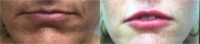 45-54 year old man treated with Juvederm