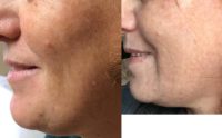 45-54 year old woman treated with Non Surgical Face Lift