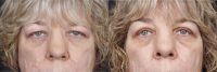 45-54 year old woman treated with Eyelid Surgery (Upper Blepharoplasty)