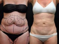 55-64 year old woman treated with Laser Liposuction to Stomach, Hips, and Thighs