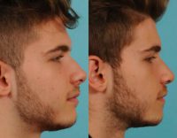 18 year old man treated with open Primary Rhinoplasty and Septoplasty