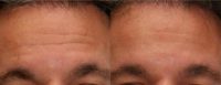 45-54 year old man treated with Botox