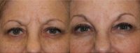 55-64 year old woman treated with Juvederm and Botox