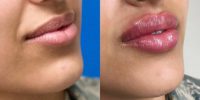 18-24 year old woman treated with Lip Augmentation