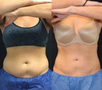 25-34 year old woman treated with CoolSculpting