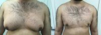 25-34 year old man treated with Tickle Lipo