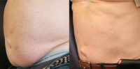 55-64 year old man treated with CoolSculpting