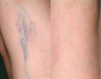 45-54 year old woman treated with Vein Treatment