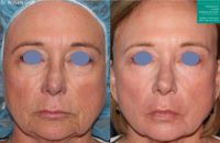 75 and up year old woman treated with Laser Resurfacing