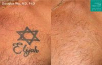 45-54 year old man treated with Tattoo Removal