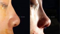 25-34 year old woman treated with Asian Rhinoplasty with DCF