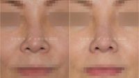 45-54 year old woman treated with Asian Rhinoplasty and Alar Base Narrowing