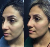 18-24 year old woman treated with Bellafill