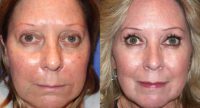 45-54 year old woman treated with Laser Resurfacing, Botox, Fillers
