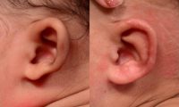 Non-surgical newborn ear correction