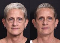 49 year old woman treated with Lip Augmentation