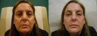 45-54 year old woman treated with Juvederm Volbella to correct her tear troughs