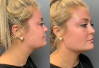 18-24 year old woman treated for Jawline contour