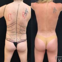 25-34 year old woman treated with BodyTite