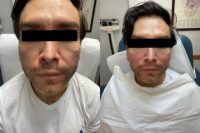 35-44 year old man treated with Nonsurgical Facelift