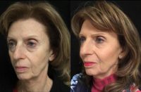 65 year old woman treated with Sculptra Aesthetic