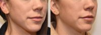 Lip Enhancement with Botox