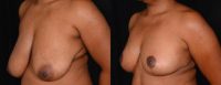 35-44 year old woman treated with Breast Lift