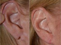 45-54 year old woman treated with Ear Lobe repair Surgery