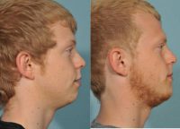 18-24 year old man treated with Chin Surgery