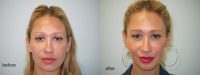 35-44 year old woman treated with Vampire Facelift