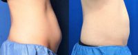 35-44 year old woman treated with CoolSculpting for Abdomen