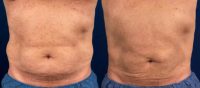 55-64 year old man treated with CoolSculpting for Abdomen