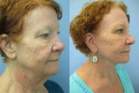 Face skin rejuvenation, woman, spot removal