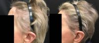 75 and up year old woman treated with PRP for Hair Loss