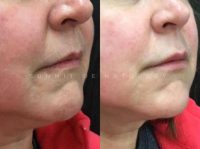 45-54 year old woman treated with Restylane Refyne