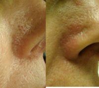 45-54 year old woman treated with Yag Laser