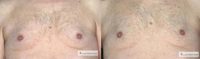 45-54 year old man treated with CoolSculpting