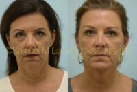 45-54 year old woman treated with Facial Fat Transfer