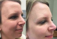 35-44 year old woman treated with Botox to Crow's Feet