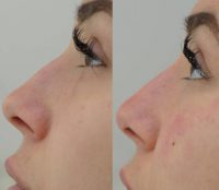 Non-Surgical Nose Enhancement