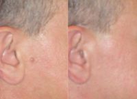35-44 year old man treated with Mole Removal