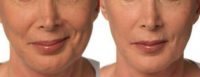 55 year old woman treated with Injectable Fillers