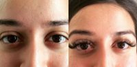 18-24 year old woman treated with Lash Lift