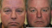 Upper and Lower Blepharoplasty and Lower Lid Fillers