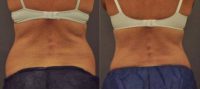 Woman treated with CoolSculpting