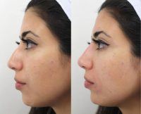 26 year old woman treated with Nonsurgical Nose Job