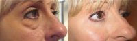 45-54 year old woman treated with Eye Bags Treatment