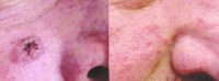 65-74 year old man treated with Skin Cancer Treatment